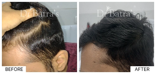 Hair Falling Treatment